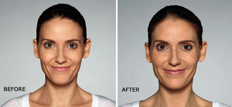 Restylane Before & After