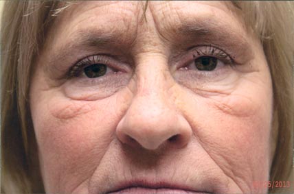 Eyelids after Blepharoplasty