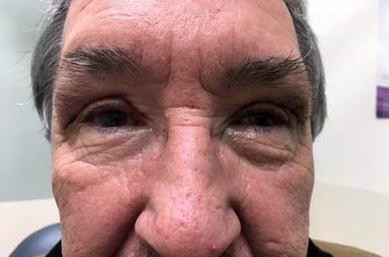 Eyelids after Blepharoplasty