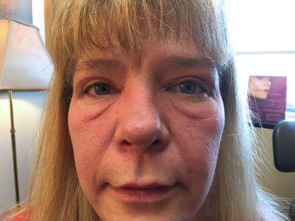 Eyelids after Blepharoplasty