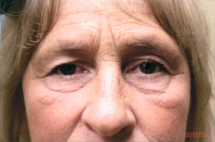 Eyelids prior to Blepharoplasty