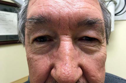 Eyelids prior to Blepharoplasty