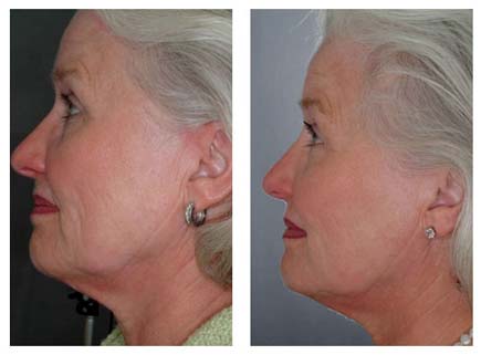 Laser collagen rejuvenation